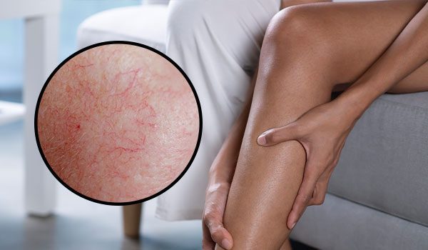 persona mayor con dolor en la pierna por arañitas